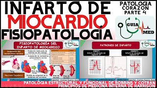 INFARTO AGUDO AL MIOCARDIO FISIOPATOLOGÍA  GuiaMed [upl. by Ecinue]