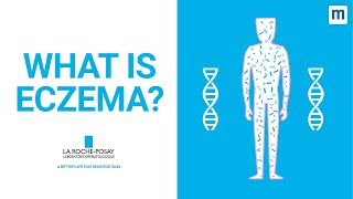 What Is Eczema  La RochePosay [upl. by Llenel]