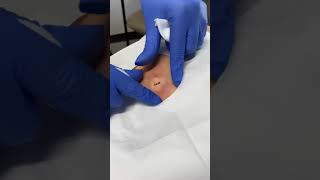 The Best Pimple Popper Video Ever This Cyst Exploded [upl. by Shaun]