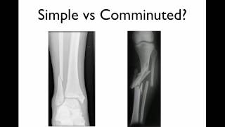 Fracture Healing Part 1  Everything You Need To Know  Dr Nabil Ebraheim [upl. by Stanwin453]