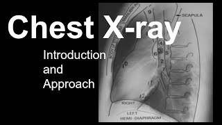 Chest Xray Introduction and Approach [upl. by Aerised149]