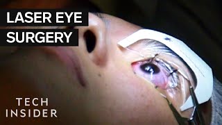 How does laser eye surgery work  Dan Reinstein [upl. by Littman]