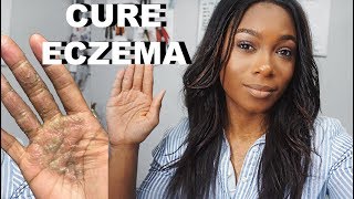 How I Cured My Eczema Fast  Trishonnastrends [upl. by Oigroig489]