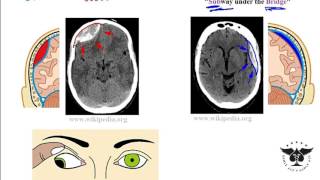 Hypothalamus Neuroanatomy Video Lab  Brain Dissections [upl. by Airdnoed838]