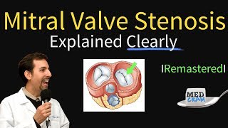 Mitral stenosis pathophysiology [upl. by Anetta]