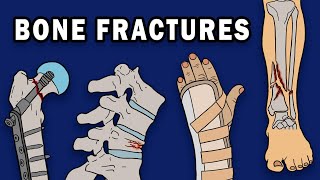 BONE FRACTURES [upl. by Idnic]