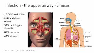 Common Variable Immune Deficiency CVID [upl. by Aitsirhc]