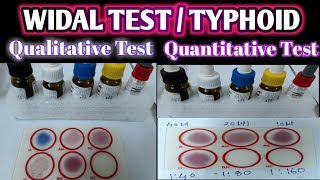 Widal Test Practical  Qualitative Widal Test  Quantitative Widal Test  Typhoid Test [upl. by Akoyn540]