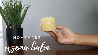 How I Get Rid of Eczema  Homemade Eczema Cream  Dry Itchy Skin Relief [upl. by Darlleen177]