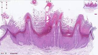 Verruca Vulgaris  Histopathology [upl. by Ysnil]