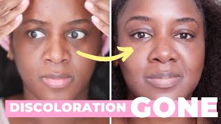 How I Got Rid of My Dark Circles Black Skin [upl. by Jesher]