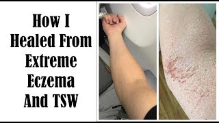 Top 10 Things To Heal From Eczema and TSW  My Journey of Healing [upl. by Wanids713]