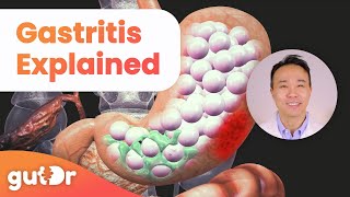 What is Gastritis  The GutDr Explains 3D Gut Animation [upl. by Akessej]