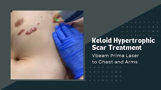 Successful Treatment of Keloid in San Antonio Boerne by Cryo Surgery Texas Institute of Dermatology [upl. by Lede]