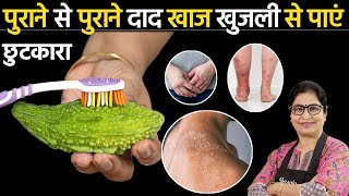 सिर्फ 3 दिन में पुराने दाद खाज खुजली को दूर करने का सबसे सफल उपाय  Ringworm Treatment Naturally [upl. by Essirahc]