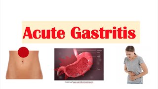 Acute Gastritis Stomach Inflammation  Causes Signs amp Symptoms Diagnosis Treatment [upl. by Olonam]