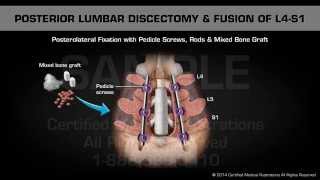 Posterior Lumbar Discectomy amp Fusion of L4S1 [upl. by Craig]