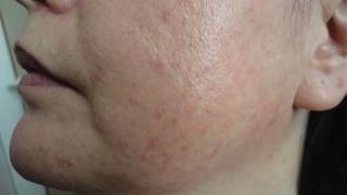 Dermoscopy of common facial inflammatory skin diseases by Dr Aimilios Lallas [upl. by Prudy551]