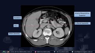 TOMOGRAFIA AXIAL BASICA DE ABDOMEN Y PELVIS [upl. by Renell]