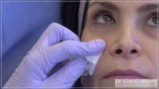 Hyaluronic Acid Gel Filling of the Lower Eyelid and Associated Hollows  Dr Massry [upl. by Thekla]