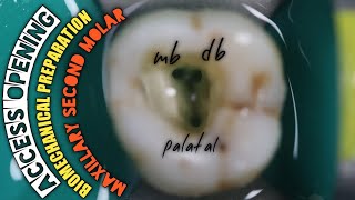 Access Opening in Maxillary Second Molar Biomechanical Preparation  Protaper Rotary Endodontics [upl. by Lemrahc]