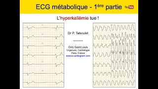 12a ECG métabolique 1 Hyperkaliemie Dr Taboulet [upl. by Hirsch]