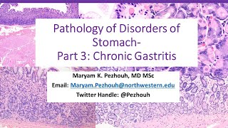 Part 3 Pathology of Gastric Disorders Chronic Gastritis [upl. by Dehlia121]