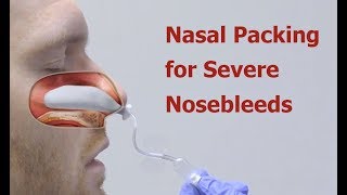 Nasal Packing for Severe Nosebleeds [upl. by Shalne]