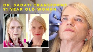 Dr Sadati Transforms 71 year old Woman with Lower Face and Neck Lift and Restylane Lyft Filler [upl. by Ayekat249]