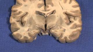 Signs and Symptoms of Brain Hemorrhage [upl. by Finnegan]