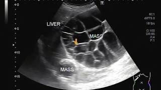 Ultrasound Video showing Hepatic hydatid cyst with a solid mass [upl. by Harpp]