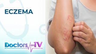 Eczema Symptoms Causes and Treatment  Doctors on TV [upl. by Ellingston]