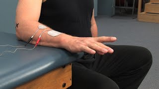 Electrode Placement for Finger Extension Muscle Stimulation [upl. by Lauzon]