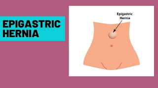 Epigastric hernia  symptoms clinical features [upl. by Horner]