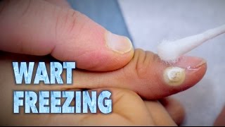 FREEZING WARTS With Sizzling Liquid Nitrogen  Dr Paul [upl. by Elimay]