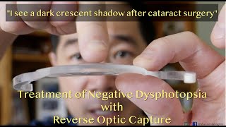 Why do I see a shadow crescent or arc after cataract surgery Treatment of Negative Dysphotopsia [upl. by Dnamra]