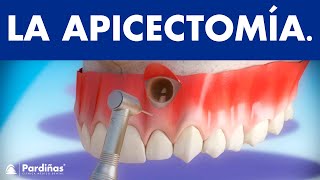 Apicectomía  Tratamiento infección de la raíz del diente © [upl. by Sik]