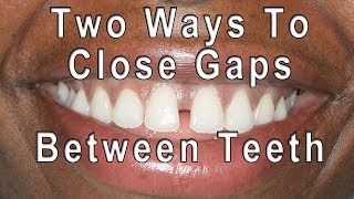 How to Close Gaps Between Teeth [upl. by Jim]