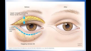 Treating Glaucoma with a Laser Procedure [upl. by Down]