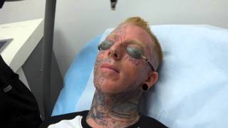 Incredible Face Tattoo Removal  3rd Treatment at Dr Tattoff [upl. by Haleemaj]