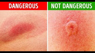 How to Identify Common Bug Bites [upl. by Idnym]