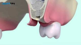 IntraLift® 3D by SATELEC® ACTEON® YouTube [upl. by Atiuqes]