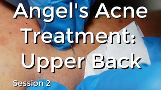 Angels Acne treatment Upper Back  Session II [upl. by Xel]