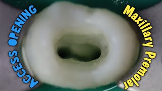 access opening of maxillary first premolar  step by step demonstration [upl. by Neffirg]