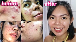 HOW I CLEARED MY ACNE  Cystic Hormonal Acne with PCOS Philippines [upl. by Caneghem]