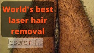 Worlds best hair removal laser [upl. by Earized]