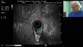 EUS of a Submucosal Tumor in the Gastric Antrum [upl. by Ramos]