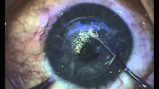 Laser Precision Restores Vision after Cataracts [upl. by Analihp]