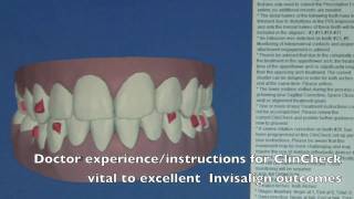 Invisalign ClinCheck Explanation [upl. by Chaffee949]