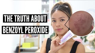 Clear Acne With Benzoyl Peroxide Pros and Cons [upl. by Noizneb]